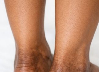 The skin around my ankles is getting darker and thicker over time. What causes this?