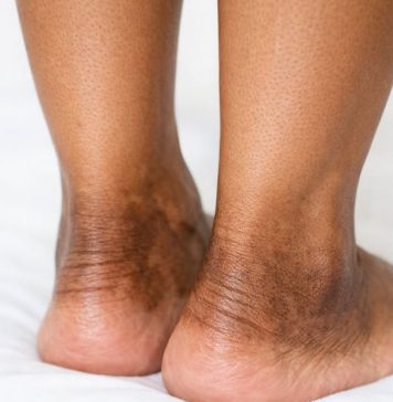 The skin around my ankles is getting darker and thicker over time. What causes this?