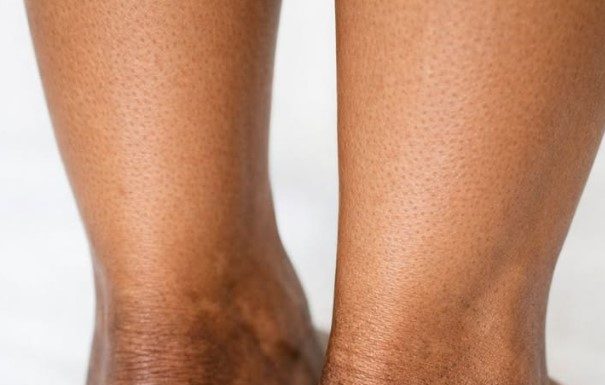 The skin around my ankles is getting darker and thicker over time. What causes this?