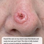Found this sore on my mom’s nose that bleeds and scabs but just won’t heal. The clinic is fully booked and I’m scared it might be something bad. Any ideas what this is?