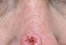 Found this sore on my mom’s nose that bleeds and scabs but just won’t heal. The clinic is fully booked and I’m scared it might be something bad. Any ideas what this is?