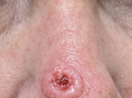 Found this sore on my mom’s nose that bleeds and scabs but just won’t heal. The clinic is fully booked and I’m scared it might be something bad. Any ideas what this is?