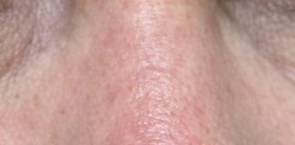 Found this sore on my mom’s nose that bleeds and scabs but just won’t heal. The clinic is fully booked and I’m scared it might be something bad. Any ideas what this is?