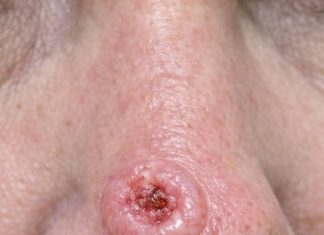 Found this sore on my mom’s nose that bleeds and scabs but just won’t heal. The clinic is fully booked and I’m scared it might be something bad. Any ideas what this is?