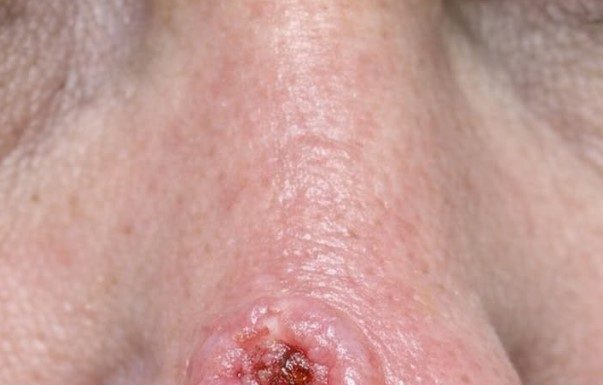 Found this sore on my mom’s nose that bleeds and scabs but just won’t heal. The clinic is fully booked and I’m scared it might be something bad. Any ideas what this is?