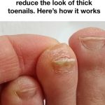 A Simple Home Routine to Improve the Look of Thick Toenails