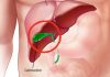How Does the Body Change After Gallbladder Removal?