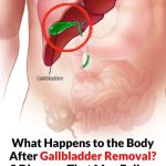 How Does the Body Change After Gallbladder Removal?