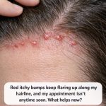 Red itchy bumps keep flaring up along my hairline, and my appointment isn’t anytime soon. What helps now?
