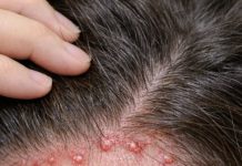 Red itchy bumps keep flaring up along my hairline, and my appointment isn’t anytime soon. What helps now?