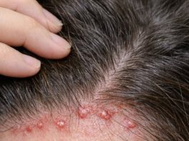 Red itchy bumps keep flaring up along my hairline, and my appointment isn’t anytime soon. What helps now?