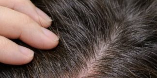 Red itchy bumps keep flaring up along my hairline, and my appointment isn’t anytime soon. What helps now?