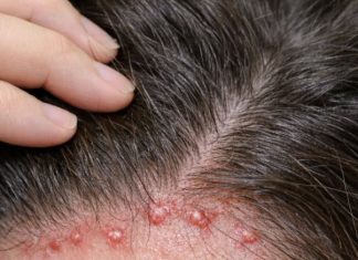 Red itchy bumps keep flaring up along my hairline, and my appointment isn’t anytime soon. What helps now?