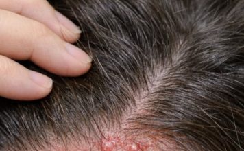 Red itchy bumps keep flaring up along my hairline, and my appointment isn’t anytime soon. What helps now?