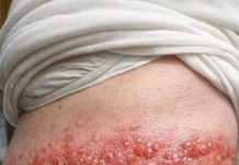 Mom has this blistering rash wrapping around her side. She says the burning pain is unbearable. ER wait is 8 hours! What can we do?