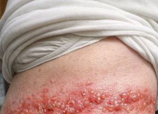 Mom has this blistering rash wrapping around her side. She says the burning pain is unbearable. ER wait is 8 hours! What can we do?