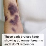 These dark bruises keep showing up on my forearms and I don’t remember bumping into anything. What’s going on?
