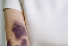 These dark bruises keep showing up on my forearms and I don’t remember bumping into anything. What’s going on?