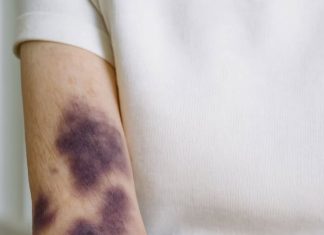 These dark bruises keep showing up on my forearms and I don’t remember bumping into anything. What’s going on?