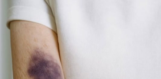 These dark bruises keep showing up on my forearms and I don’t remember bumping into anything. What’s going on?