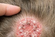 I was brushing my little girl’s hair and found this round, scaly bald spot. It looks so angry and I’m terrified it will spread to the other kids before our appointment on Monday. Please help!