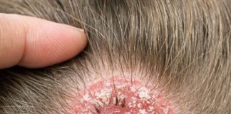 I was brushing my little girl’s hair and found this round, scaly bald spot. It looks so angry and I’m terrified it will spread to the other kids before our appointment on Monday. Please help!