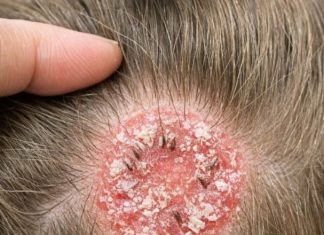 I was brushing my little girl’s hair and found this round, scaly bald spot. It looks so angry and I’m terrified it will spread to the other kids before our appointment on Monday. Please help!