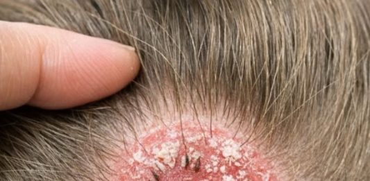 I was brushing my little girl’s hair and found this round, scaly bald spot. It looks so angry and I’m terrified it will spread to the other kids before our appointment on Monday. Please help!