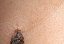 Rub this 1 mixture on your neck and get rid of skin tags, dark spots, and raised bumps