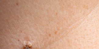 Rub this 1 mixture on your neck and get rid of skin tags, dark spots, and raised bumps