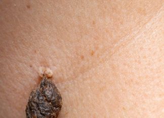 Rub this 1 mixture on your neck and get rid of skin tags, dark spots, and raised bumps