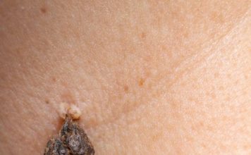 Rub this 1 mixture on your neck and get rid of skin tags, dark spots, and raised bumps