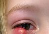My daughter just woke up screaming with this giant lump on her eyelid. It looks infected. We are hours from an ER. What is this?