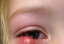 My daughter just woke up screaming with this giant lump on her eyelid. It looks infected. We are hours from an ER. What is this?