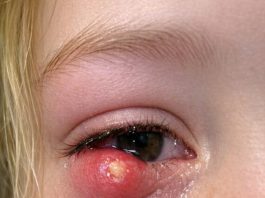 My daughter just woke up screaming with this giant lump on her eyelid. It looks infected. We are hours from an ER. What is this?