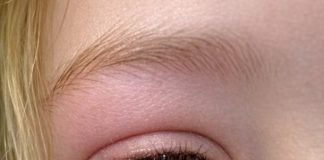 My daughter just woke up screaming with this giant lump on her eyelid. It looks infected. We are hours from an ER. What is this?