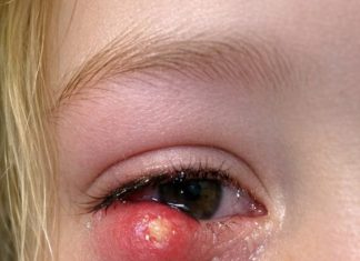 My daughter just woke up screaming with this giant lump on her eyelid. It looks infected. We are hours from an ER. What is this?