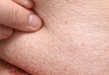 A red sore rash keeps forming under my belly fold in winter, and my doctor isn’t available yet. What helps now?