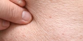 A red sore rash keeps forming under my belly fold in winter, and my doctor isn’t available yet. What helps now?