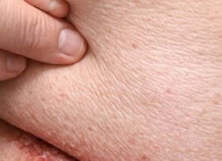 A red sore rash keeps forming under my belly fold in winter, and my doctor isn’t available yet. What helps now?