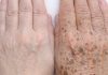 Apply this 1 solution to your hands and get rid of age spots, sun damage, and crepey skin
