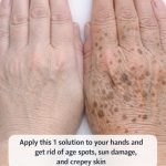 Apply this 1 solution to your hands and get rid of age spots, sun damage, and crepey skin