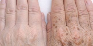 Apply this 1 solution to your hands and get rid of age spots, sun damage, and crepey skin