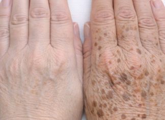 Apply this 1 solution to your hands and get rid of age spots, sun damage, and crepey skin