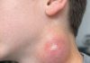 My son just showed me this painful lump on the side of his neck. It appeared overnight and he is really scared. The pediatrician is closed for the weekend. Any advice?