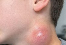 My son just showed me this painful lump on the side of his neck. It appeared overnight and he is really scared. The pediatrician is closed for the weekend. Any advice?