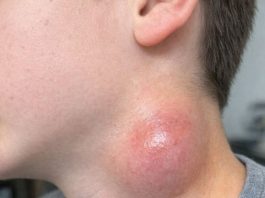 My son just showed me this painful lump on the side of his neck. It appeared overnight and he is really scared. The pediatrician is closed for the weekend. Any advice?