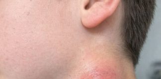 My son just showed me this painful lump on the side of his neck. It appeared overnight and he is really scared. The pediatrician is closed for the weekend. Any advice?