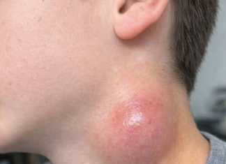 My son just showed me this painful lump on the side of his neck. It appeared overnight and he is really scared. The pediatrician is closed for the weekend. Any advice?