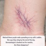 Noticed these purple webs spreading on my wife’s ankles. She says they sting by the end of the day. Dermatologist is booked out for months. Are these dangerous?
